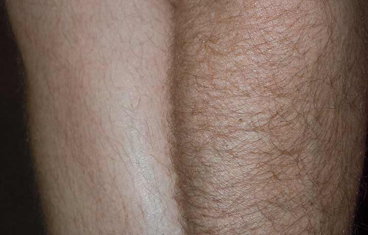 Leg hair bleaching before and after